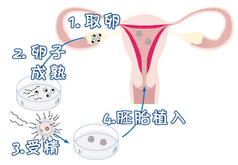 借精试管助孕